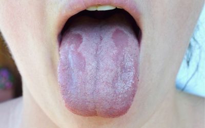 Candida: the Gut Health Silent Disruptor